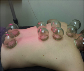 cupping